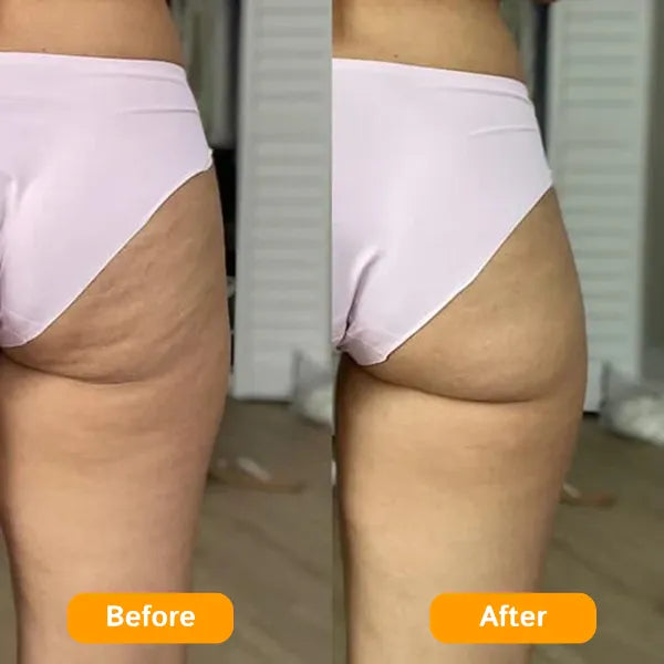 Z3 ZemoKL Cellulite Remover