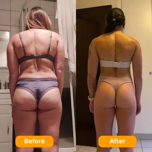 Z3 ZemoKL Cellulite Remover